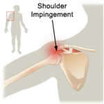 impingement